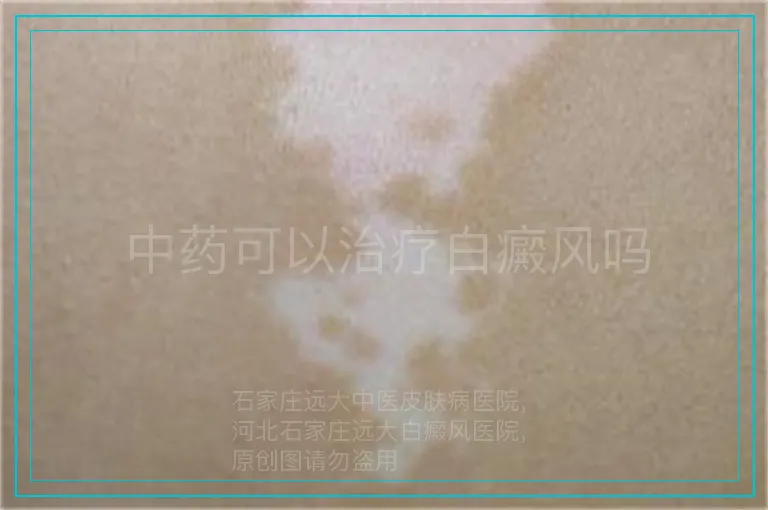 中药可以治疗白癜风吗