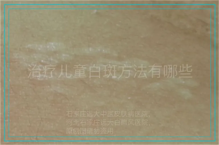 治疗儿童白斑方法有哪些