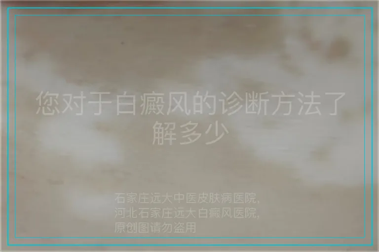 您对于白癜风的诊断方法了解多少