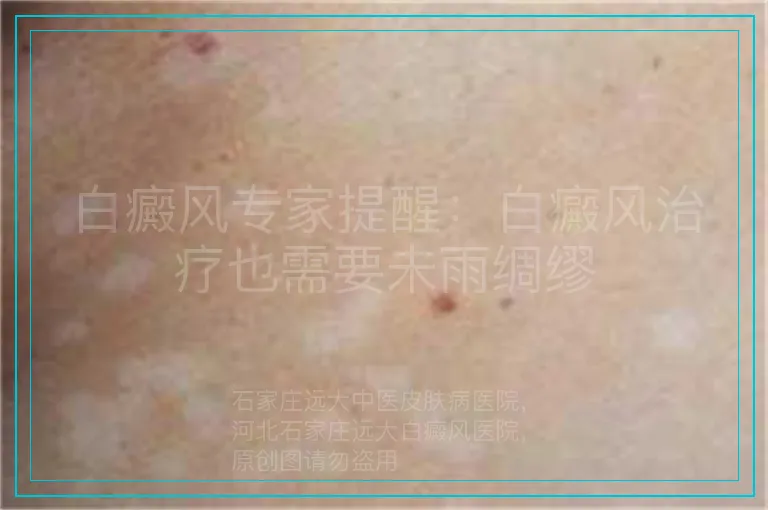 白癜风专家提醒:白癜风治疗也需要未雨绸缪