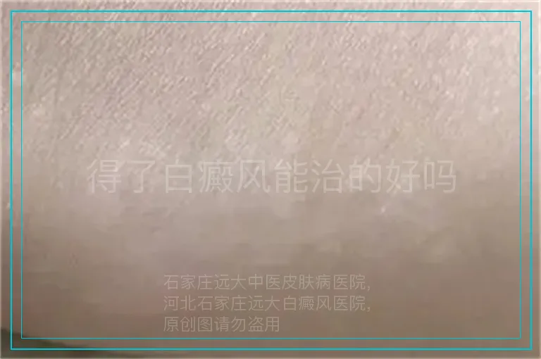 得了白癜风能治的好吗
