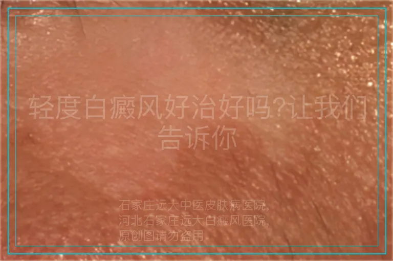 轻度白癜风好治好吗?让我们告诉你