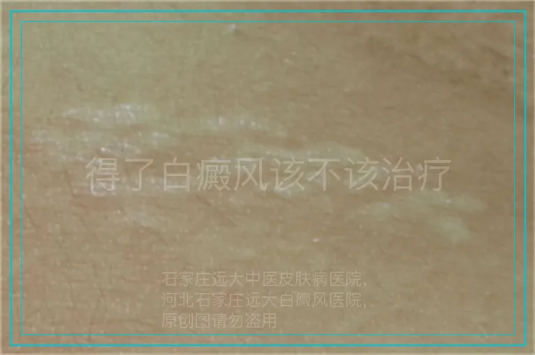 得了白癜风该不该治疗