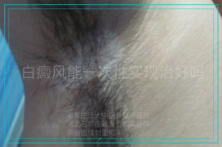 白癜风能一次性实现治好吗