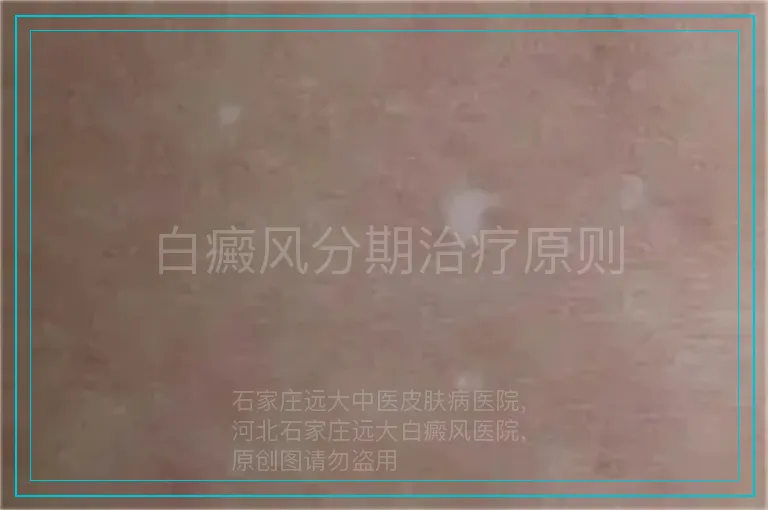 白癜风分期治疗原则