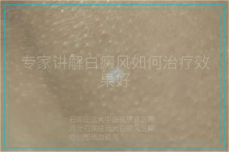 专家讲解白癜风如何治疗效果好
