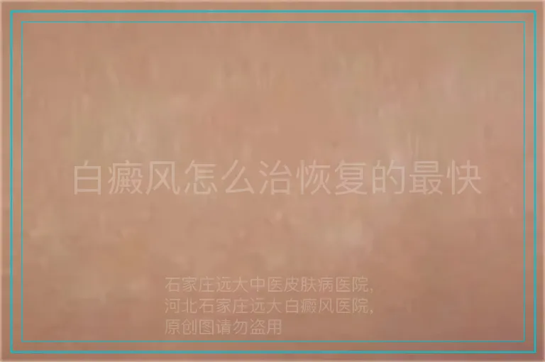 白癜风怎么治恢复的最快