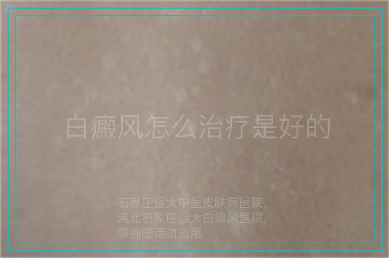 白癜风怎么治疗是好的