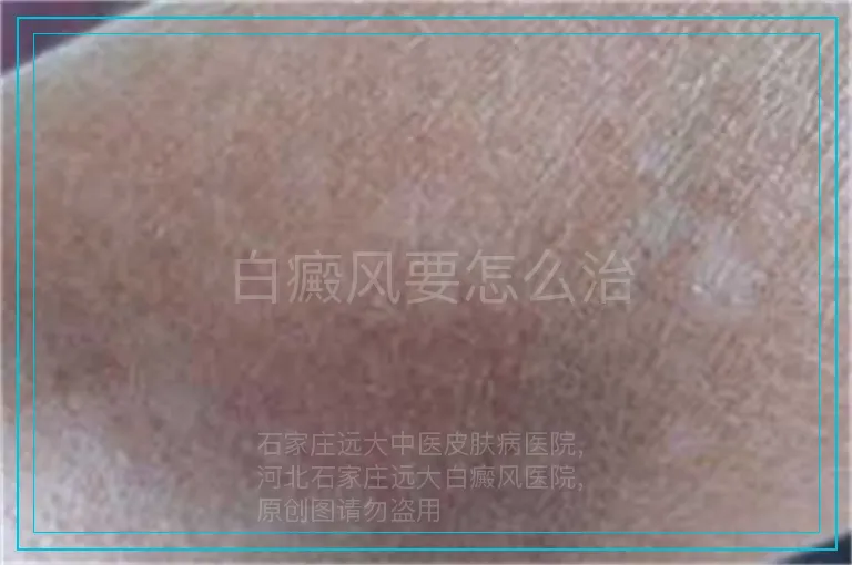 白癜风要怎么治