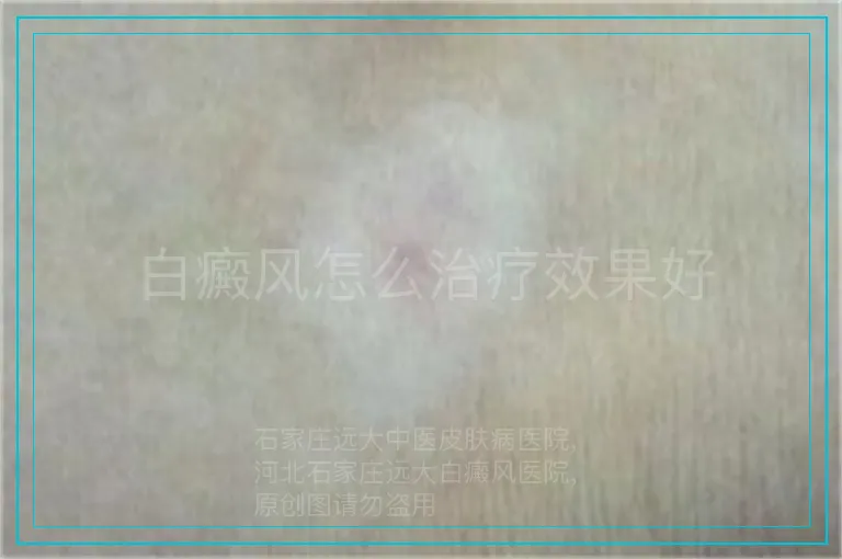 白癜风怎么治疗效果好