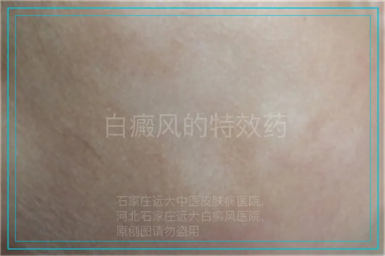 白癜风的特效药