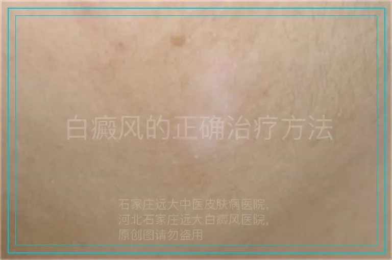 白癜风的正确治疗方法