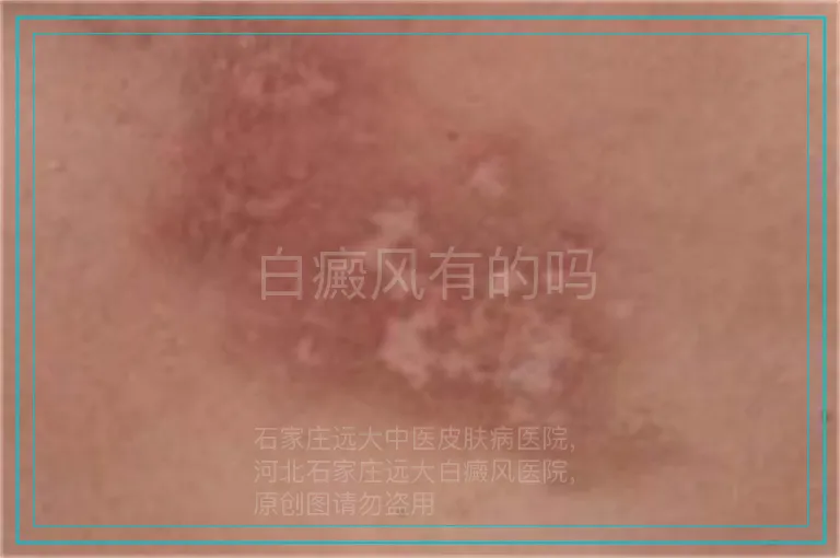 白癜风有的吗
