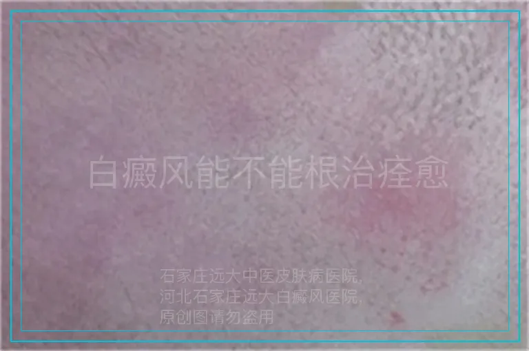 白癜风能不能根治痊愈
