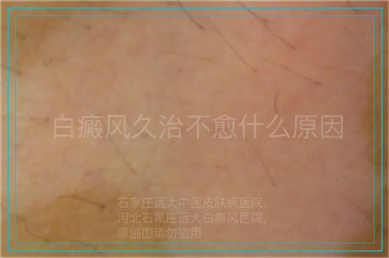 白癜风久治不愈什么原因