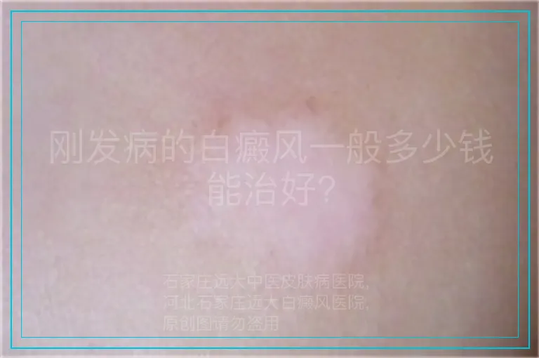 刚发病的白癜风一般多少钱能治好?