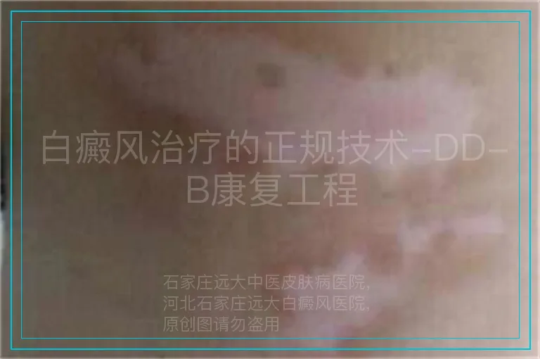 白癜风治疗的正规技术-DD-B康复工程