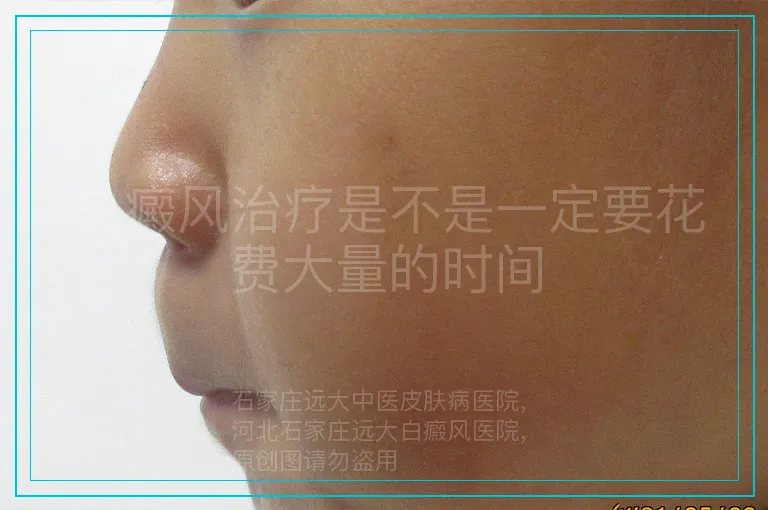 白癜风治疗是不是一定要花费大量的时间
