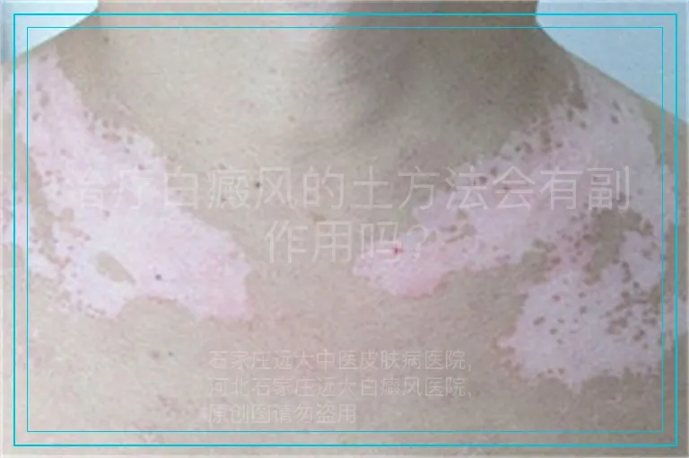 治疗白癜风的土方法会有副作用吗?