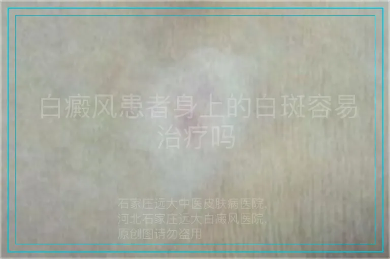 白癜风患者身上的白斑容易治疗吗