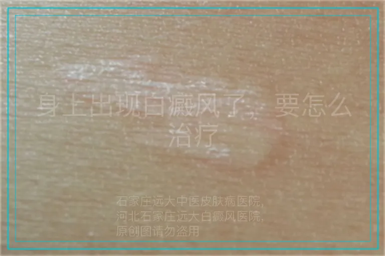 身上出现白癜风了,要怎么治疗