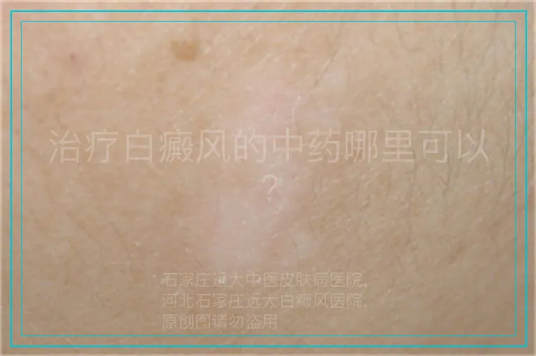 治疗白癜风的中药哪里可以?