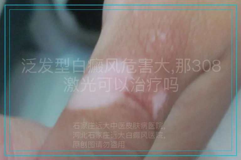 泛发型白癜风危害大,那308激光可以治疗吗