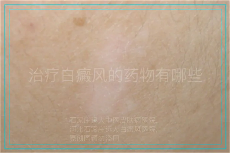 治疗白癜风的药物有哪些
