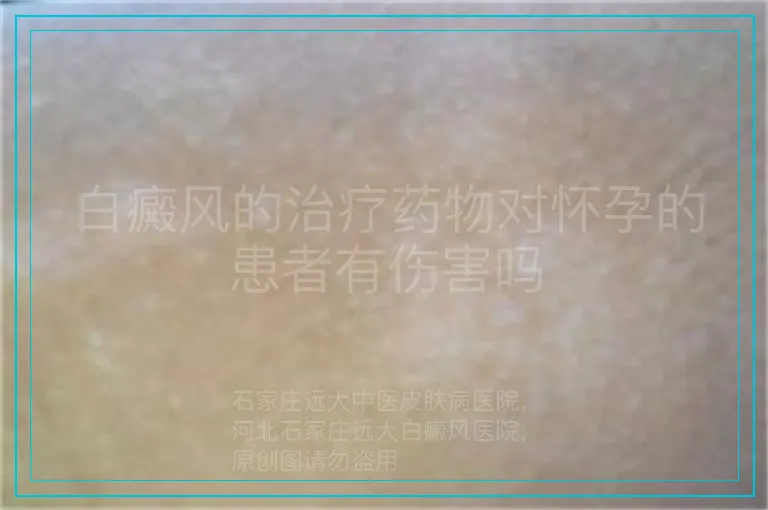 白癜风的治疗药物对怀孕的患者有伤害吗