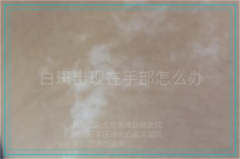 白斑出现在手部怎么办