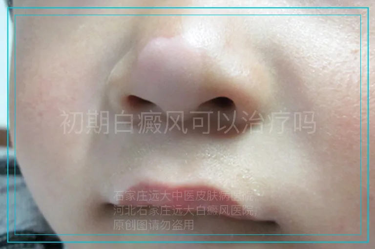 初期白癜风可以治疗吗
