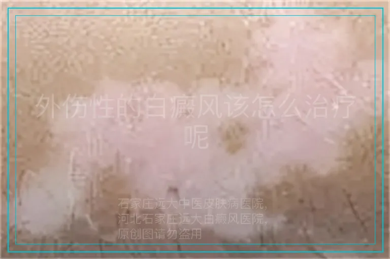 外伤性的白癜风该怎么治疗呢