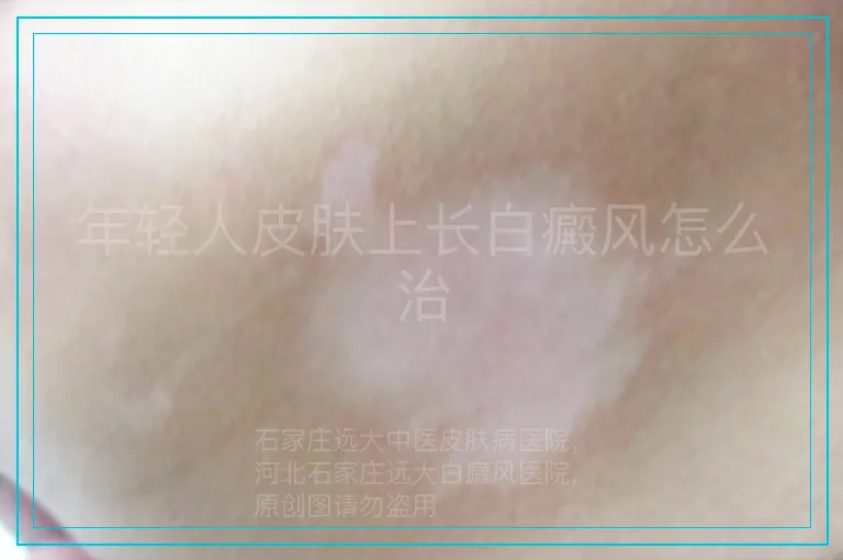 年轻人皮肤上长白癜风怎么治