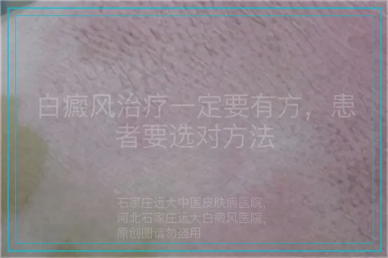 白癜风治疗一定要有方,患者要选对方法