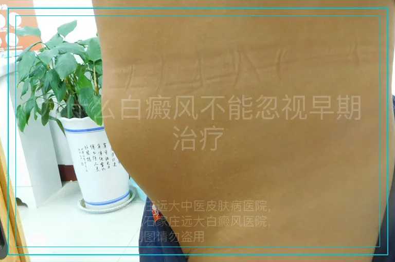 为什么白癜风不能忽视早期治疗
