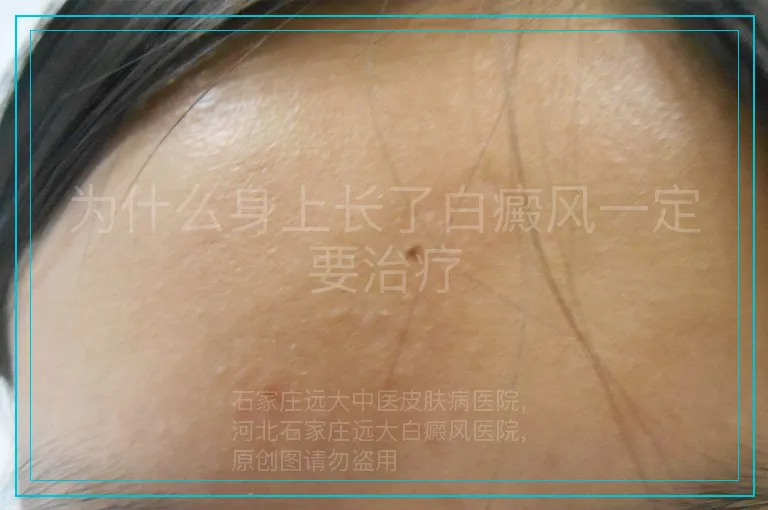 为什么身上长了白癜风一定要治疗
