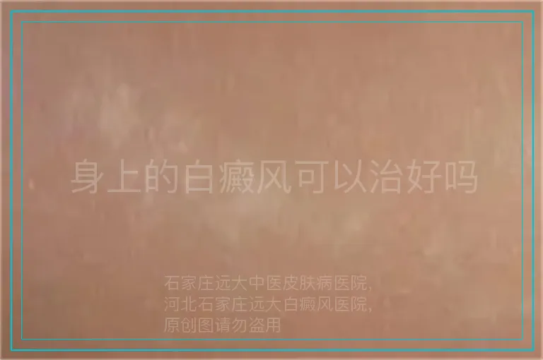 身上的白癜风可以治好吗