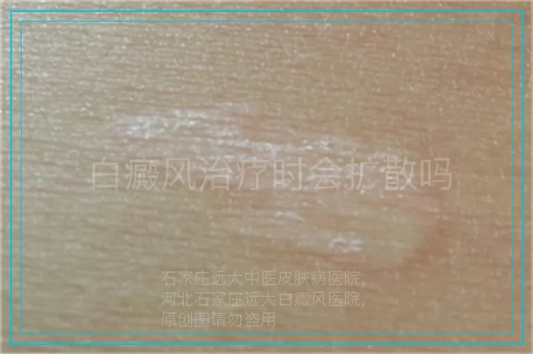 白癜风治疗时会扩散吗