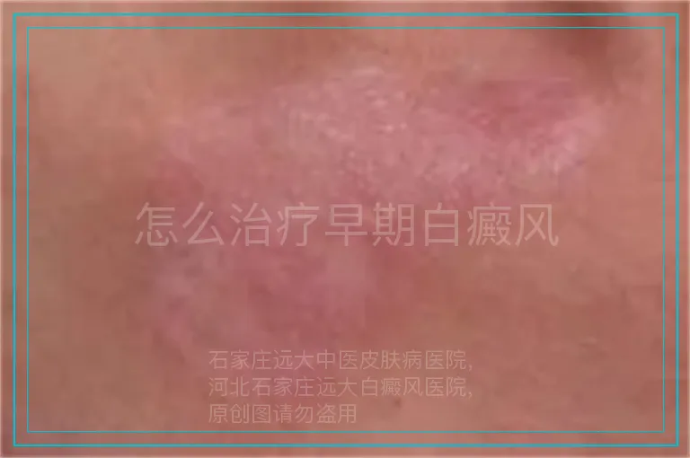 怎么治疗早期白癜风