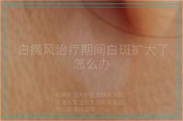 白癜风治疗期间白斑扩大了怎么办