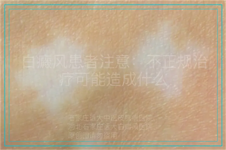 白癜风患者注意:不正规治疗可能造成什么