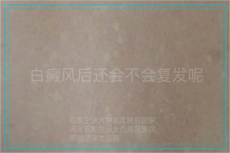 白癜风后还会不会复发呢