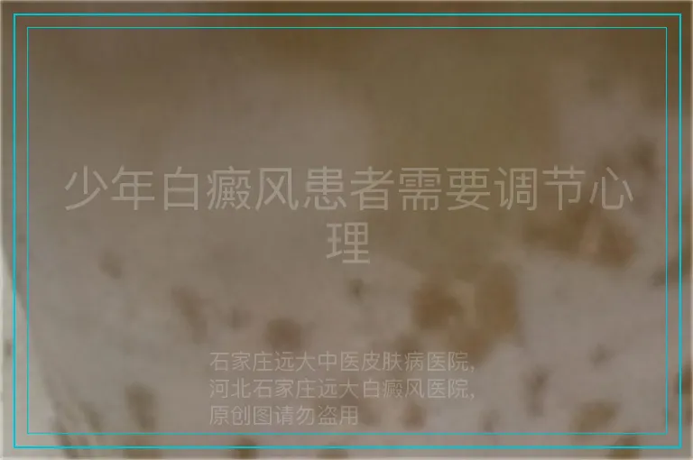 少年白癜风患者需要调节心理
