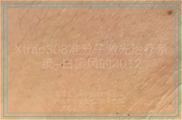 Xtrac308准分子激光治疗系统-白癜风的2012