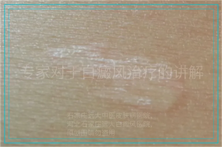 专家对于白癜风治疗的讲解