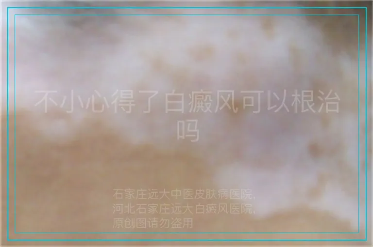 不小心得了白癜风可以根治吗