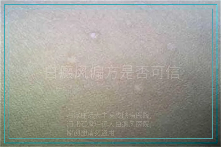白癜风偏方是否可信