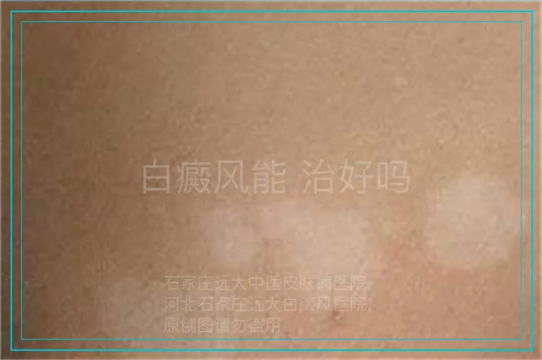 白癜风能 治好吗