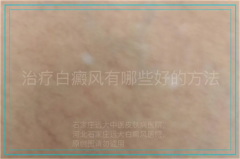 治疗白癜风有哪些好的方法