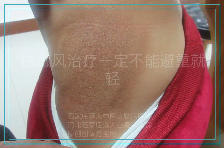 白癜风治疗一定不能避重就轻